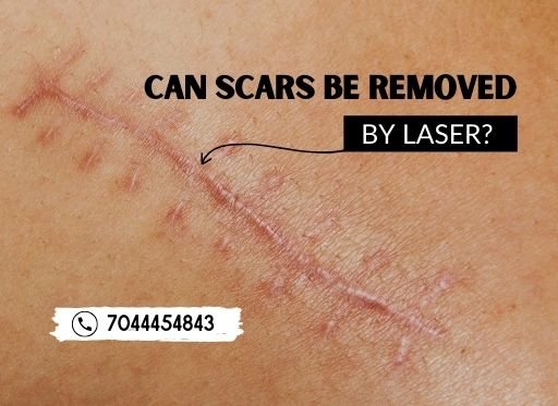 Can scars be removed by laser?