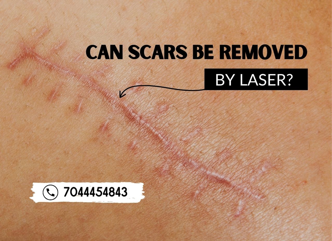  Can scars be removed by laser?