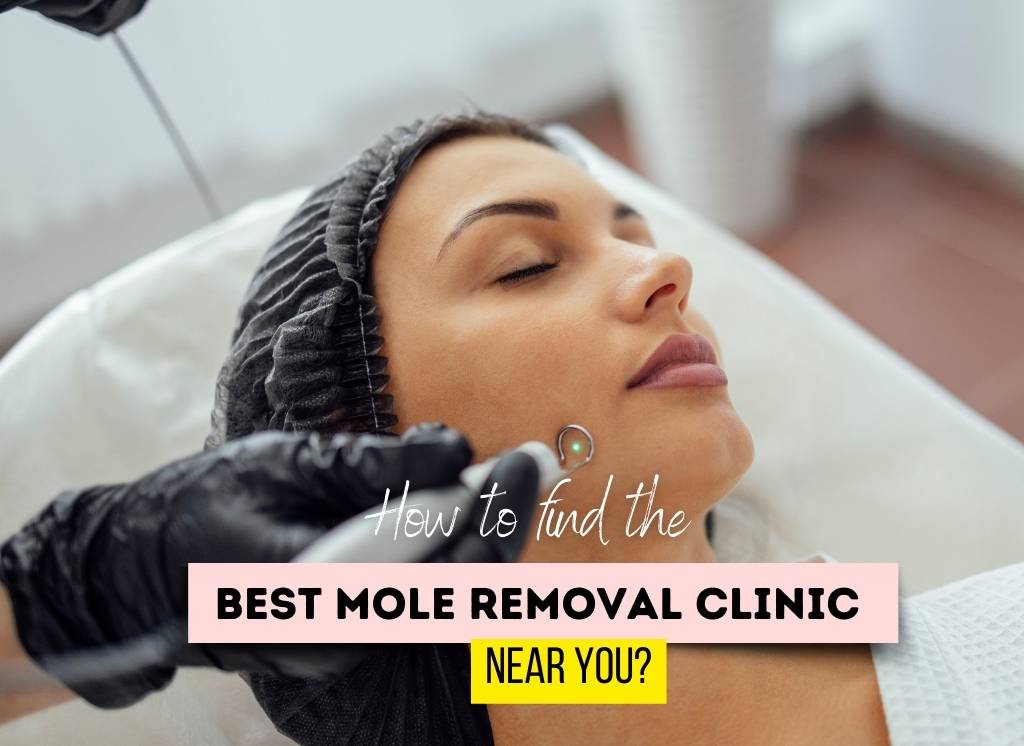  How to find the best mole removal clinic near you?