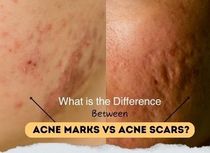 What is the Difference Between Acne Marks vs. Acne Scars?