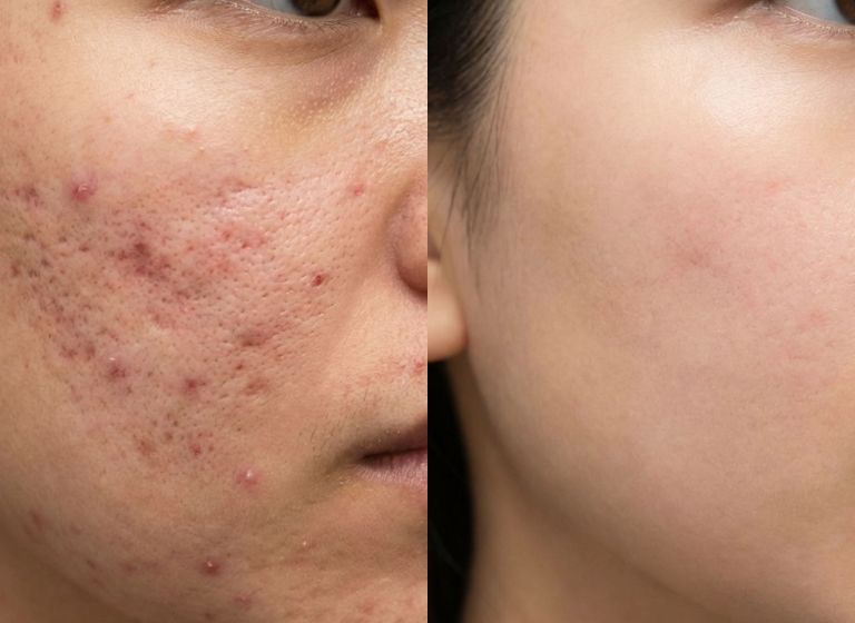 Acne scar removal cost in Kolkata showing before and after results of acne scar treatment with smoother and clearer skin.