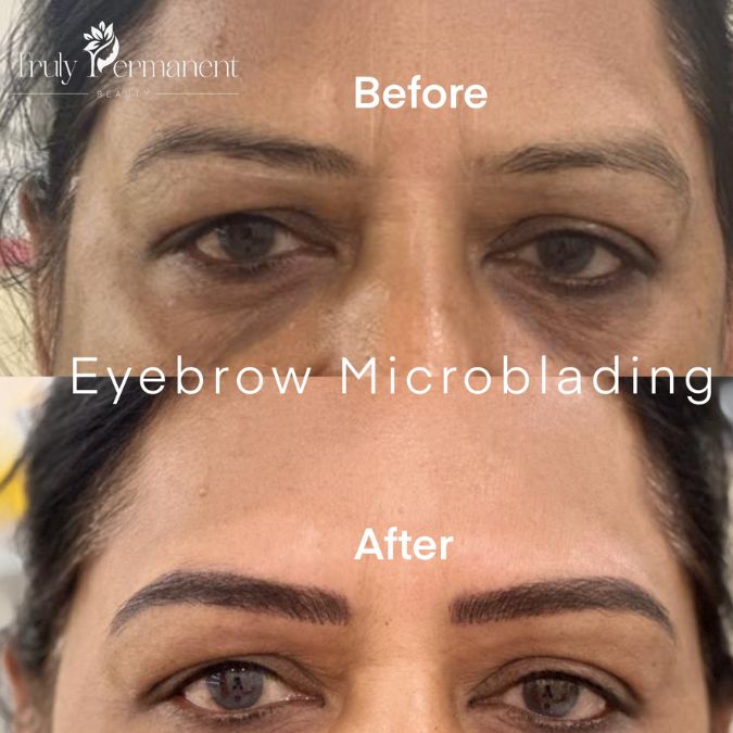 Before and after eyebrow microblading treatment correcting uneven eyebrows with realistic hair strokes at a leading semi permanent makeup clinic in Kolkata.