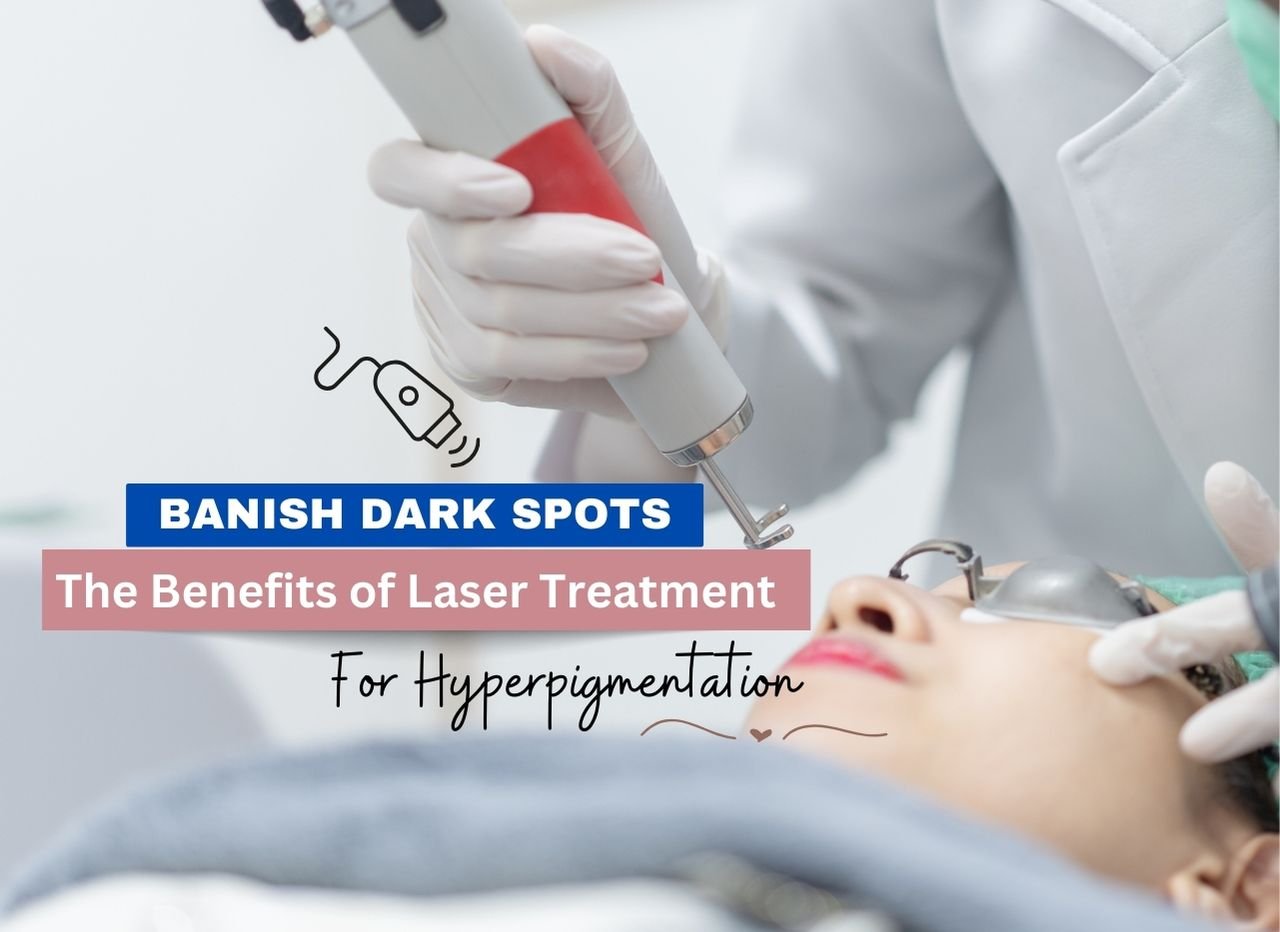 The Benefits of Laser Treatment for Hyperpigmentation