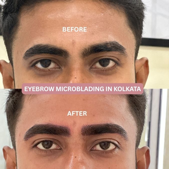 Eyebrow microblading before and after results in Kolkata showing natural hair stroke brows for Indian skin tone