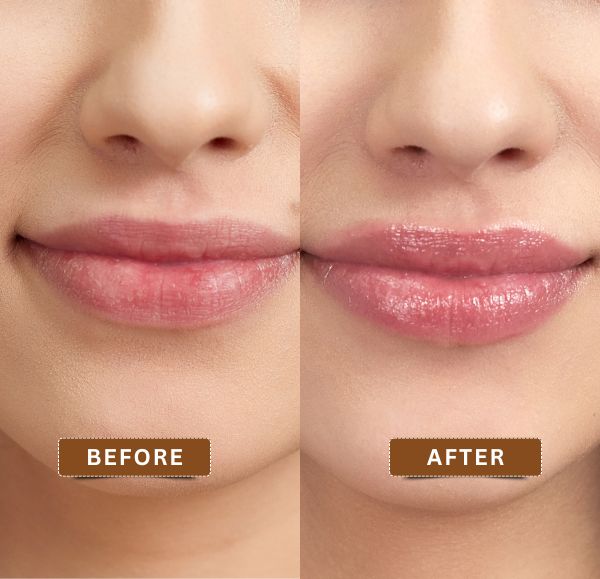 Before and after results of permanent lip lightening treatment in Kolkata showing reduced pigmentation at Truly Permanent Beauty.