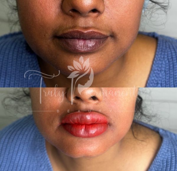 Transformation through lip pigmentation treatment: visible results of brighter and healthier lips.