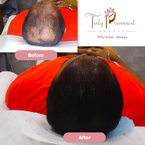 Before and after the hair mapping treatment in Kolkata that makes your hair look voluminous and hides your bald patches