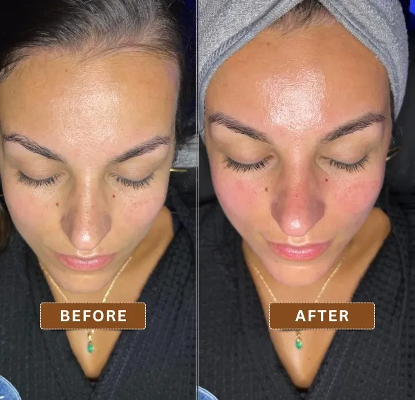 Impressive before and after comparison showcasing clearer, hydrated skin post-HydraFacial in Kolkata.