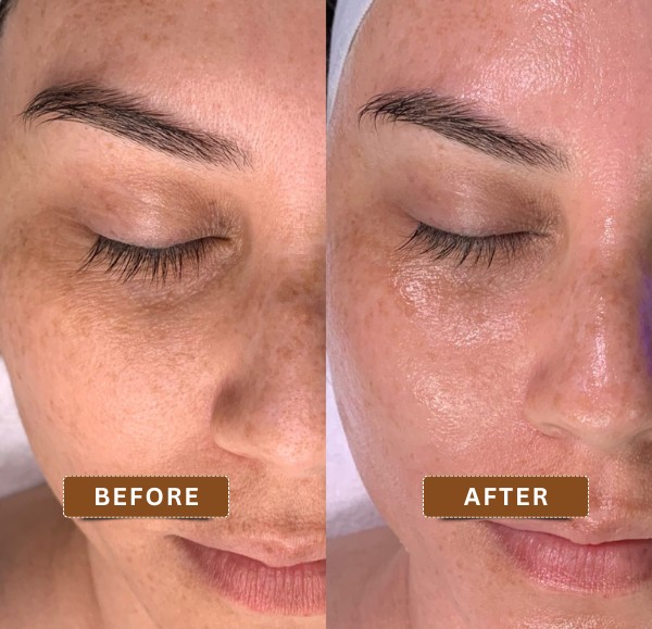 Before and after images of a HydraFacial treatment showing improved skin texture and radiance at Truly Permanent Beauty, Kolkata.