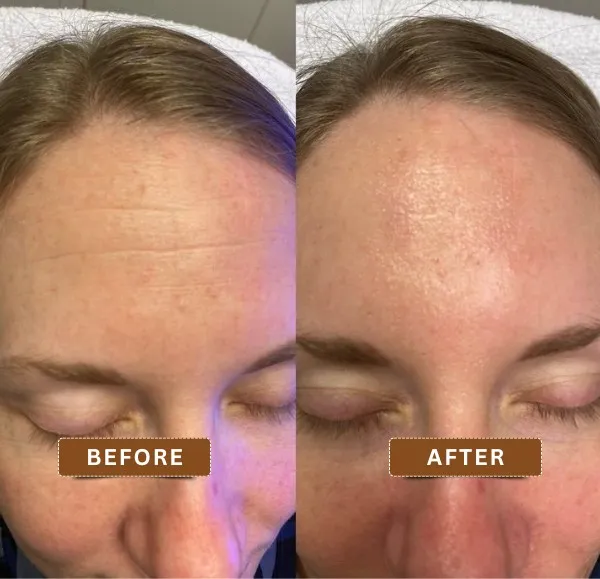 Stunning before and after images of a HydraFacial in Kolkata revealing radiant skin transformation at Truly Permanent Beauty.