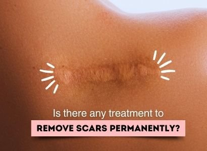 A deep scar with a question that Is there any treatment to remove scars permanently.