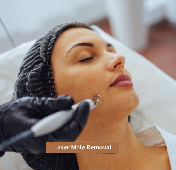 laser mole removal treatment in kolkatah