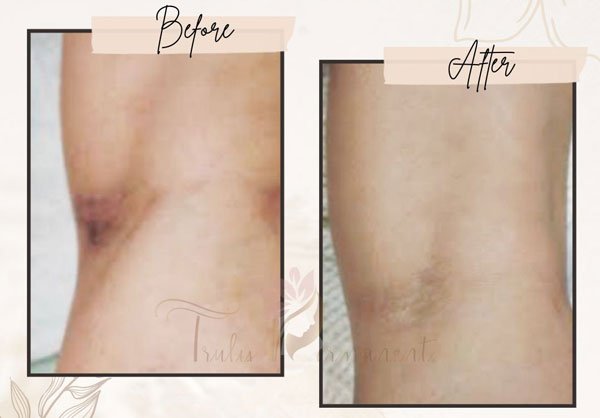 For such amazing results of before and after scar removal in Kolkata on legs, get it done from Truly Permanent Beauty