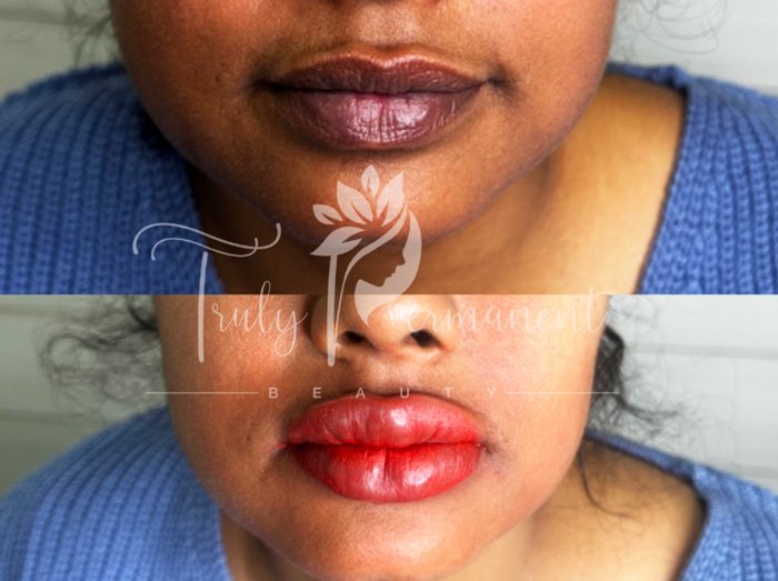 Lip plumping and sculpting