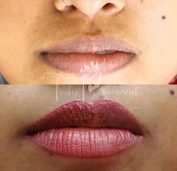 Before and after results of lip pigmentation treatment in Kolkata - Smooth, even-toned lips for a natural look.