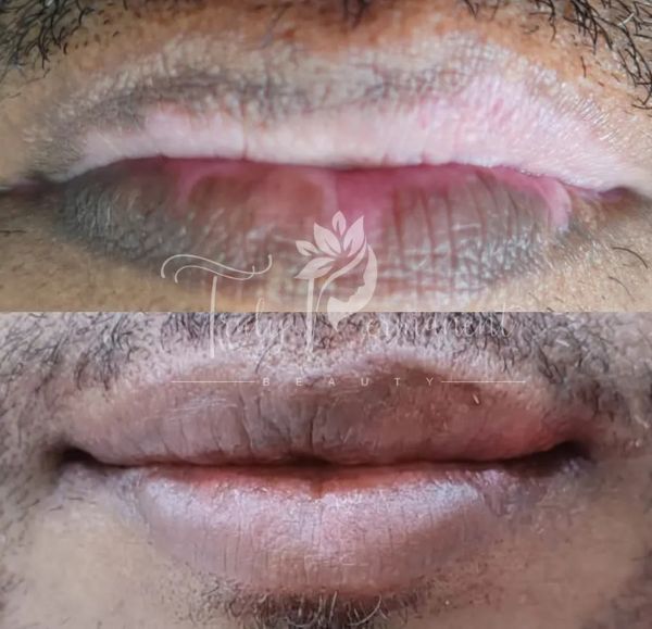 Transformation through lip pigmentation: Faded lips restored to a rich and natural tone in a single session.