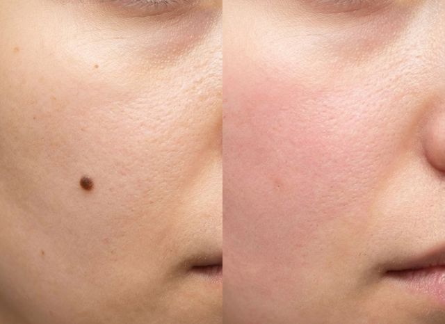 Before and after mole removal treatment showing clear skin results for mole removal cost in Kolkata.