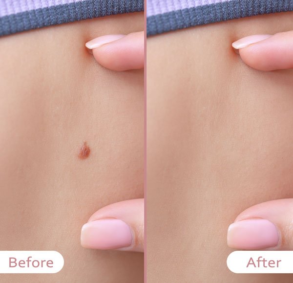 mole removal treatment before after on the stomach