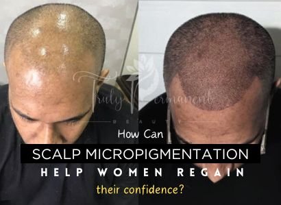 How can Scalp micropigmentation help women regain their confidence?