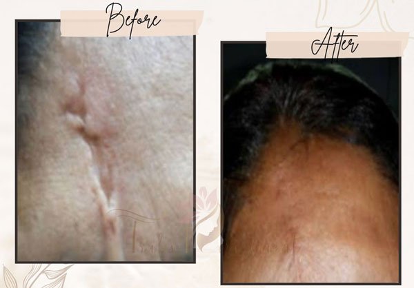 See before and after the scar removal in Kolkata from the Head at Truly Permanent Beauty. You can see visible results.